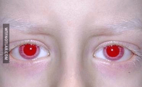 Mor ve Kırmızı gözler, Albino 3